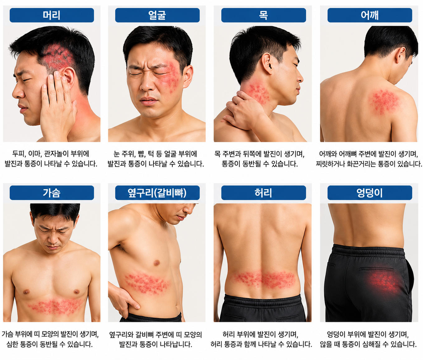머리와 얼굴, 목, 어깨, 가슴, 옆구리, 허리와 엉덩이에 나타날 수 있는 대상포진 부위 안내